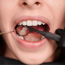 Tooth Filling