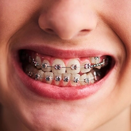 Dental Braces